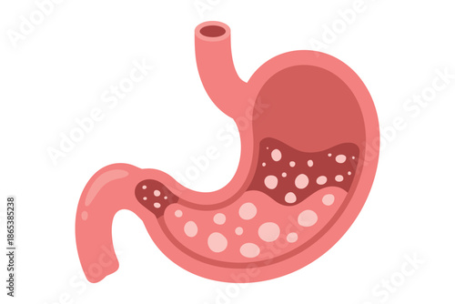 An illustration of a human stomach with bubbles inside, representing digestive issues or gas.