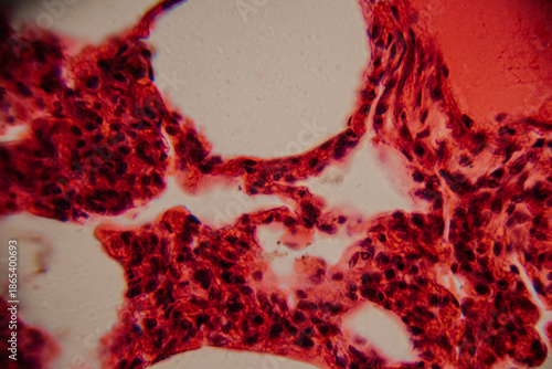 Fotografija Histological image showing bone marrow tissue with dense clusters of reddish-stained hematopoietic cells and visible white fat areas at high magnification