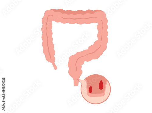 Hemorrhoids Disease Clip Art Illustration
