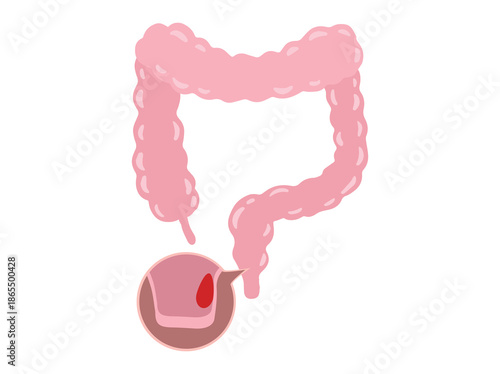 Hemorrhoids Disease in Intestine Illustration
