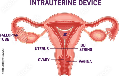 Intrauterine device medical illustration, labeled female reproductive system diagram showing uterus, fallopian tubes, ovaries, vagina, and IUD placement