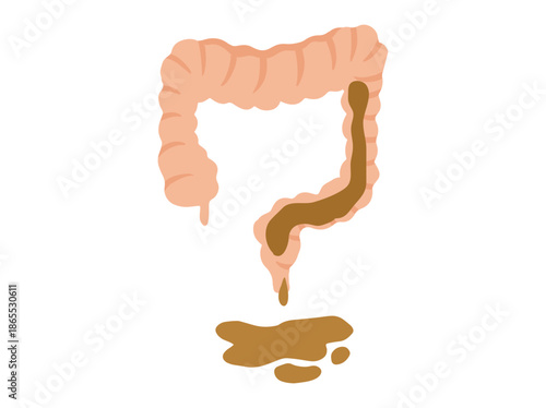 Diarrhea Disease in Intestines Illustration
