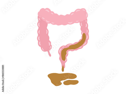 Diarrhea Disease in Intestines Illustration
