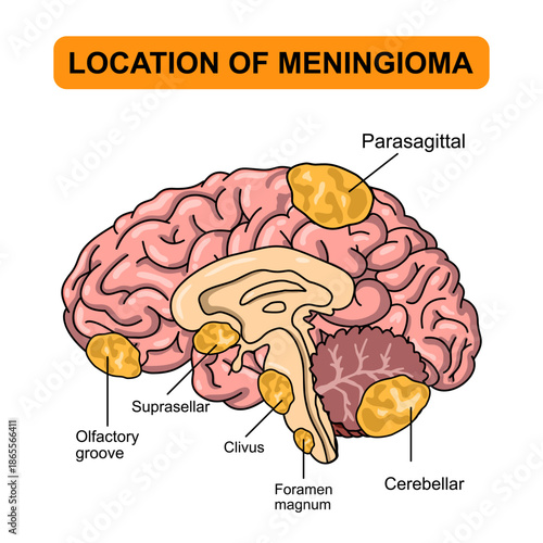 Illustration of the location of meningioma in the brain. Tumors in the brain membrane and spinal cord. Inflammation of meninges. Vector illustrations for medical, posters, education.