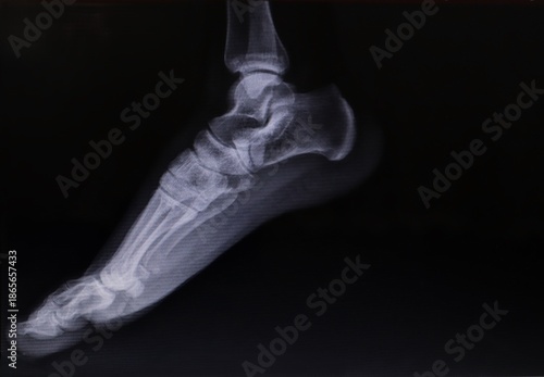 Clinical lateral ankle and foot X-ray demonstrating normal bone structure and correct anatomical alignment. for radiology reference and healthcare or medical education use