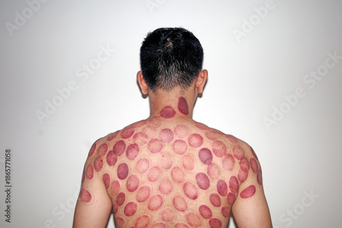 back view of asian man with circular bruises after cupping therapy. traditional chinese medicine treatment for pain relief and muscle tension. red marks on skin from suction cups.