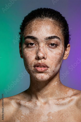 Portrait of a woman with vitiligo on colorful background