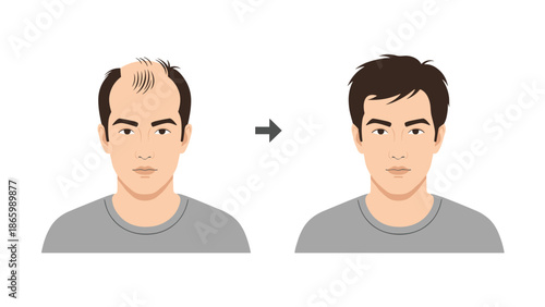 Comparison of a man before and after hair transplantation, showing significant hair loss on one side and a full, healthy head of hair on the other.
