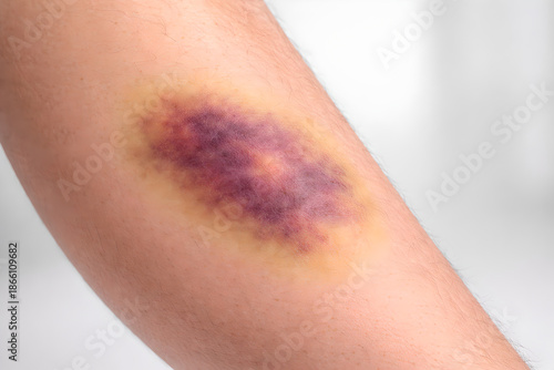 Photorealistic 3D macro close-up of subcutaneous bruising (ecchymosis) on human forearm irregular bluish-purple discoloration with soft gradient edges, mild swelling optional
