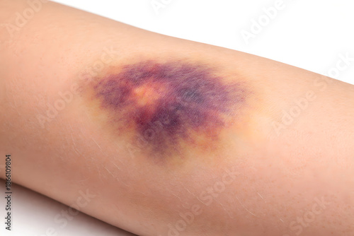 Photorealistic 3D macro close-up of subcutaneous bruising (ecchymosis) on human forearm irregular bluish-purple discoloration with soft gradient edges, mild swelling optional