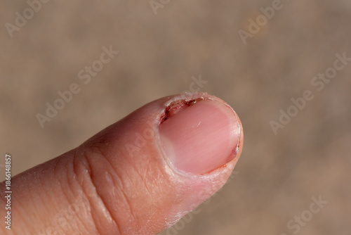 Slika na platnu Acute Paronychia Infection on Fingernail Close-Up