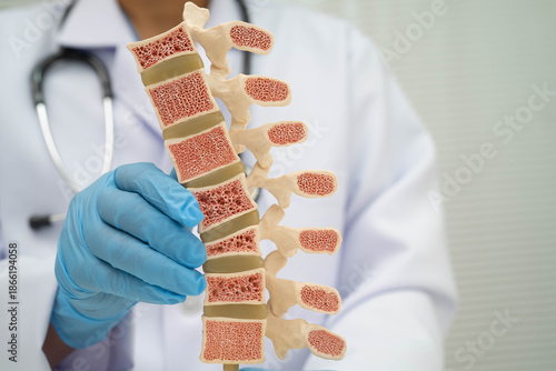 Bild auf Leinwand Doctor holding osteoporosis in back bone model for treatment medical in orthopedic department