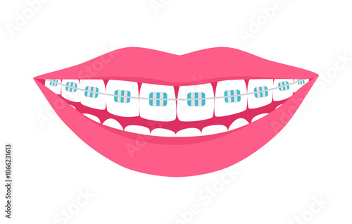 Smiling mouth with dental braces. Smiling teeth. Orthodontic Treatment Concept. Vector isolated illustration.