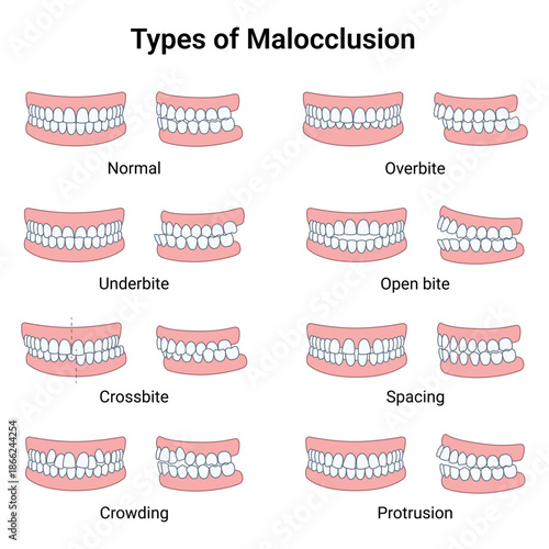 Types of Malocclusion and Normal Human Teeth. Vector Medical Illustration.

