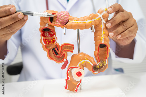 Colorectal cancer, doctor holding intestine colon human anatomy model.