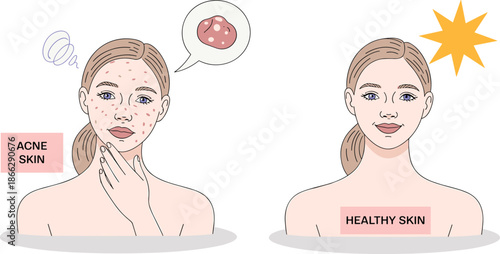 Acne skin versus healthy skin comparison, facial illustration with pimple icon and sparkle symbol, skincare concept, dermatology awareness, beauty care