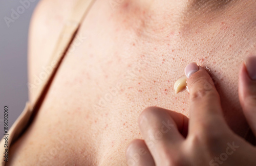 Φωτογραφία A girl smears red pimples on her body skin with healing ointment after dermatolo