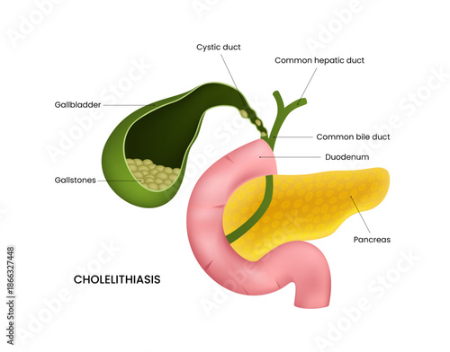 Cholelithiasis Gallstones in the Gallbladder and Biliary System
