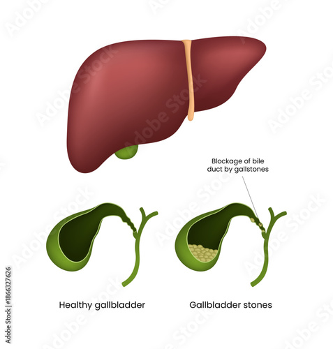 Gallstones Understanding Gallbladder and Bile Duct Blockage