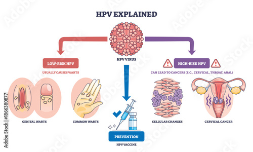 HPV explained overview illustrates virus types, vaccine syringe, and cervix, showing how low-risk cause warts and high-risk lead to cancer, with prevention guidance. Outline diagram