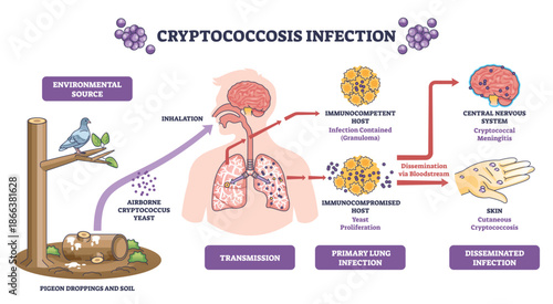 Cryptococcosis infection overview shows airborne yeast inhaled from soil to lungs, spreading via bloodstream to brain and skin, key objects, lungs, brain, yeast. Diagram
