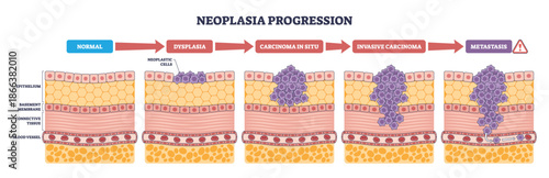 Neoplasia progression visualizes the shift from normal epithelium to dysplasia, carcinoma in situ, invasion, and metastasis, key elements, epithelium, neoplastic cells, arrows. Diagram