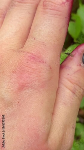 mosquito bites a person's hand