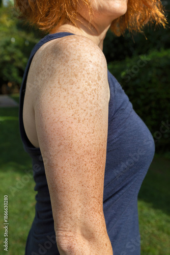 Side view of freckled arm and shoulder of fair-skinned red-haired woman
