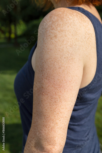 Side view of freckled arm and shoulder of fair-skinned red-haired woman