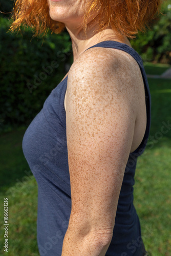 Side view of freckled arm and shoulder of fair-skinned red-haired woman