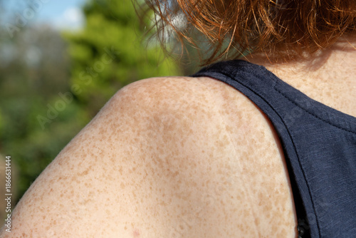 Close-up of freckles on shoulder and upper back of fair-skinned red-haired woman