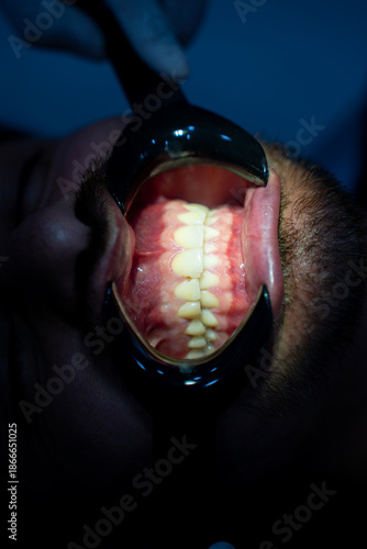 Fotografie Open mouth dental inspection with cheek retractor in clinic