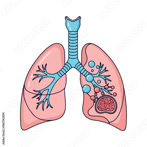 Illustration of human lungs with trachea and bronchi, highlighting a healthy left lung and a diseased right lung with a tumor, against a white background.