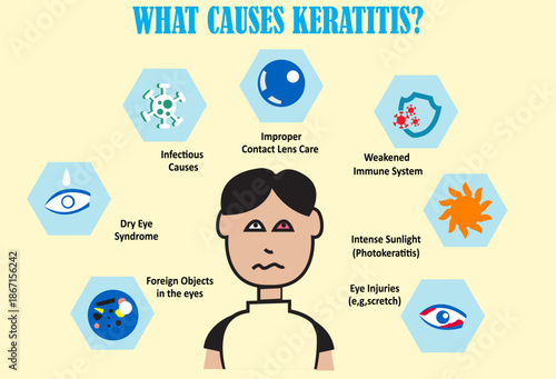 What Causes Keratitis, inflammation of the cornea