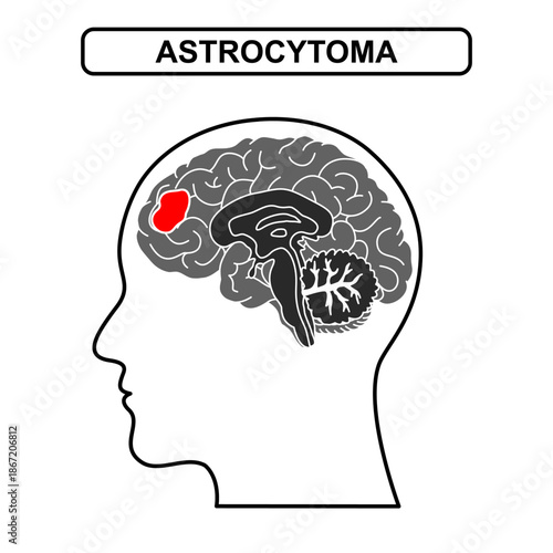 Illustration of astrocytoma. Tumor, cancer in the human brain. Illustration of brain disease. Vector nerve illustration for medical concept, poster, diagram, science or health element infographic