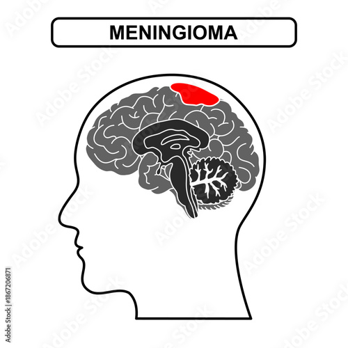 Illustration of meningioma. Tumor, cancer in the human brain. Illustration of brain disease. Vector nerve illustration for medical concept, poster, diagram, science or health element infographic