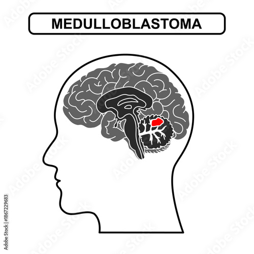 Illustration of medulloblastoma. Tumor, cancer in the human brain. Illustration of brain disease. Vector nerve illustration for medical concept, poster, diagram, science or health element infographic