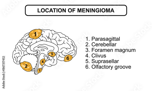 location of meningioma in the brain. Tumors in the brain membrane and spinal cord. Inflammation of meninges. Vector drawing illustrations for medical, posters, health and education.