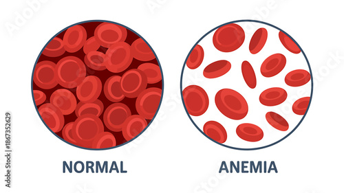 Comparison of Normal and Anemia Red Blood Cells Illustration