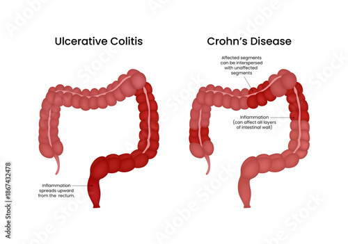 Ulcerative Colitis vs Crohn's Disease Intestinal Inflammation Comparison