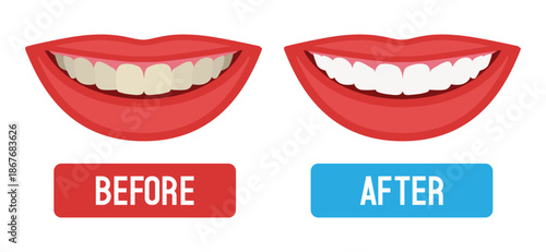 Teeth whitening. Before and after. Vector flat illustration.