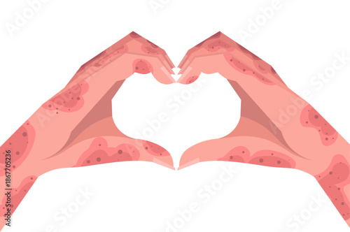 Two hands with skin issues making a heart gesture isolated on white background. Skin rash, psoriasis, dermatitis or eczema. Vector Not AI generated