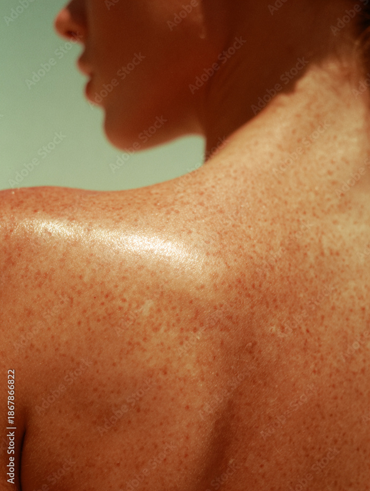 Fototapeta premium Close up of freckles (ephelides), health, skin care category. UV exposure, sun sensitivity, UV Damage. 