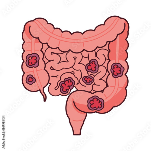 Large intestine icon displaying polyp growth for digestive health concept