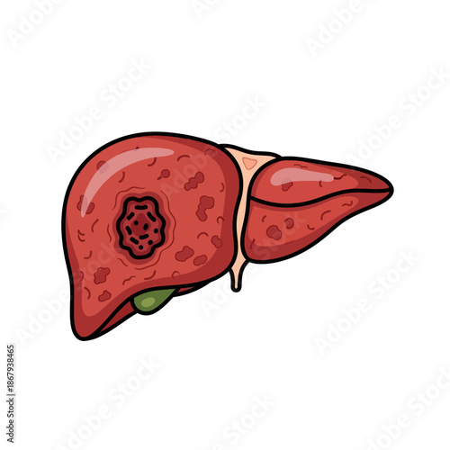 Liver Cancer and Cirrhosis Cartoon Vector Illustration, Diseased Human Organ with Tumor and Inflammation