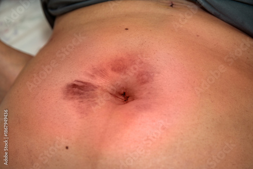 Postoperative abdominal bruise after gallbladder surgery, laparoscopic cholecystectomy recovery