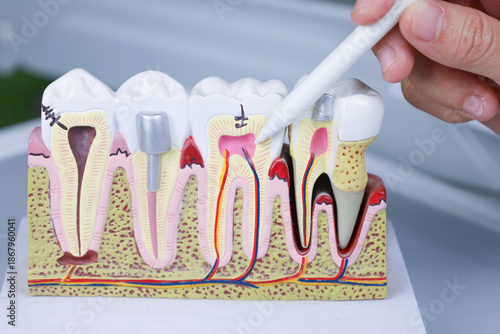 Close-up of an educational dental model displaying internal tooth structure, layers, and pathology for patient consultation
