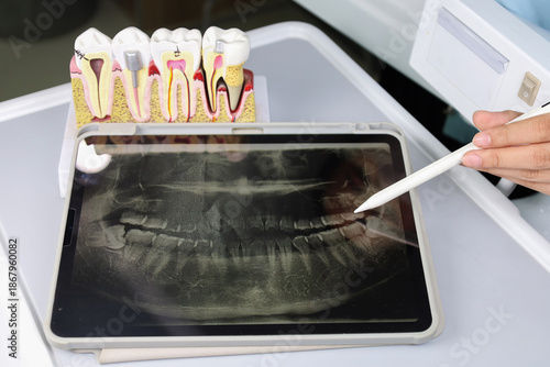 Dentist pointing at a digital panoramic X-ray on a tablet screen, highlighting an impacted wisdom tooth. Dental anatomy model in the background.