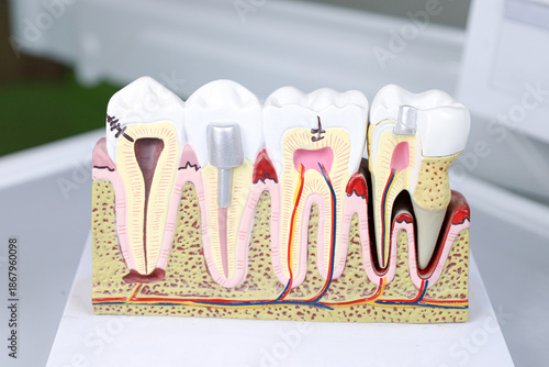Close-up of an educational dental model displaying internal tooth structure, layers, and pathology for patient consultation