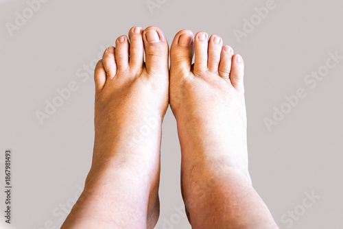 Close-up of a swollen foot and ankle showing edema, a symptom of fluid retention. Represents a medical condition, injury, or health problem related to the circulatory or lymphatic system.